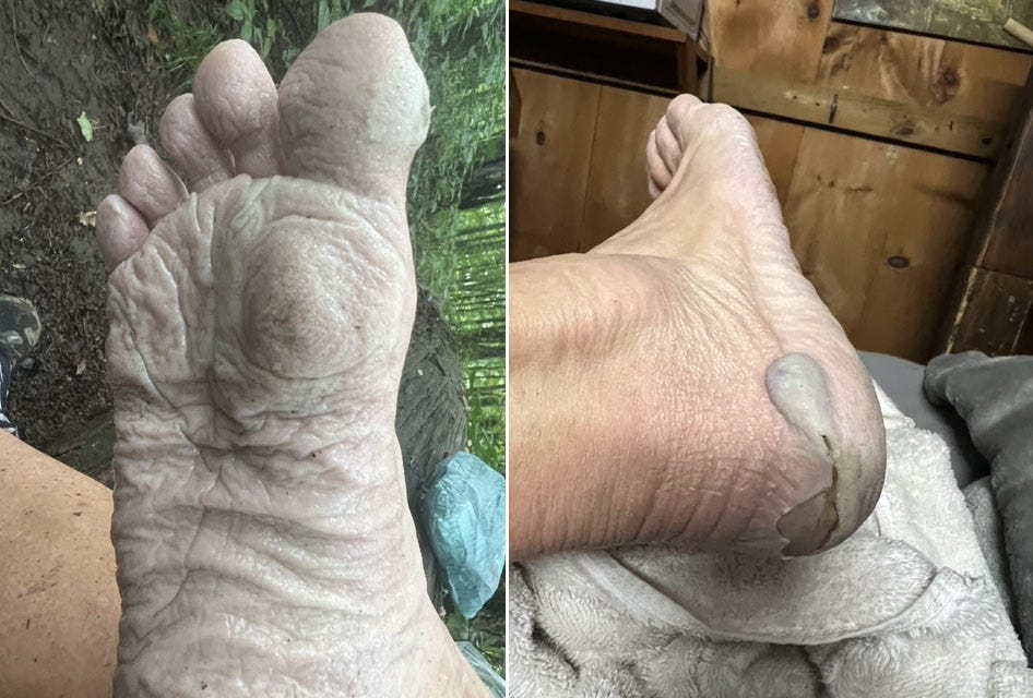 Thru-Hiker’s Appalachian Trail Record Attempt Spoiled by Some Funky Feet