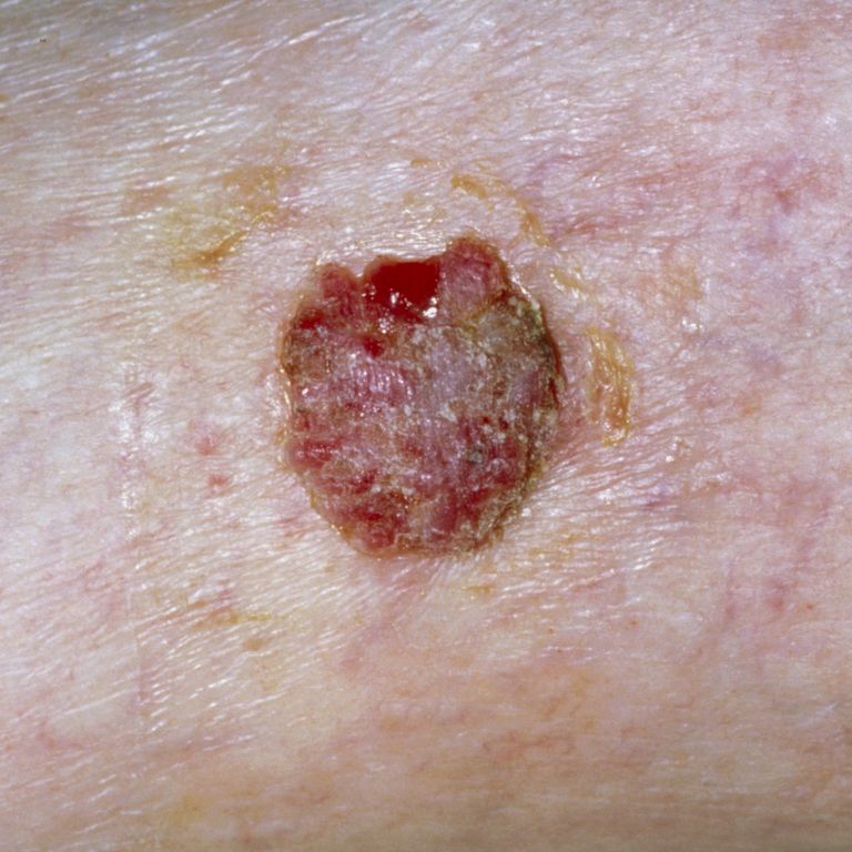 Early Squamous Cell Skin Cancer Signs