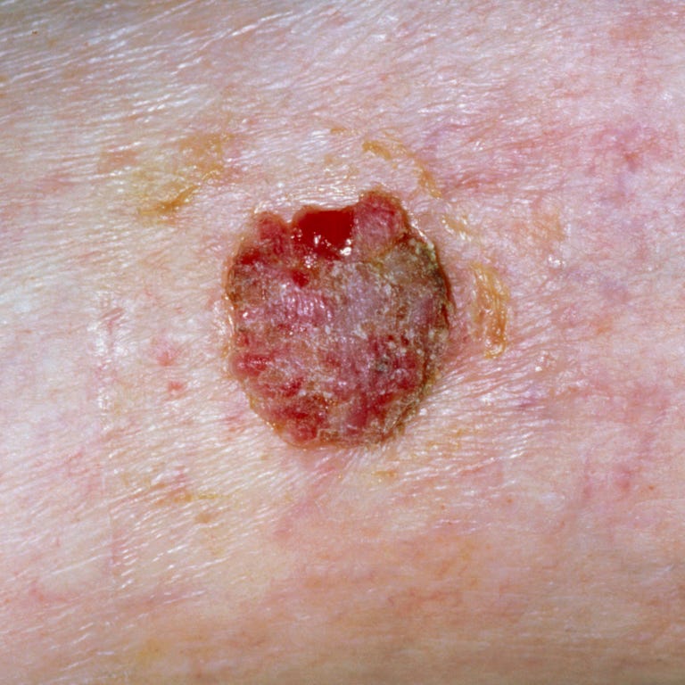 Early Squamous Cell Skin Cancer Signs