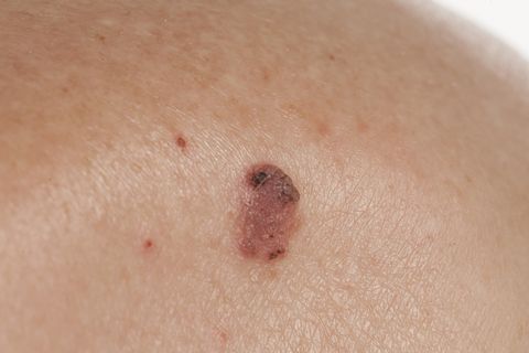 basal squamous cell carcinoma