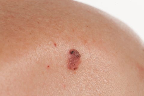 basal squamous cell carcinoma