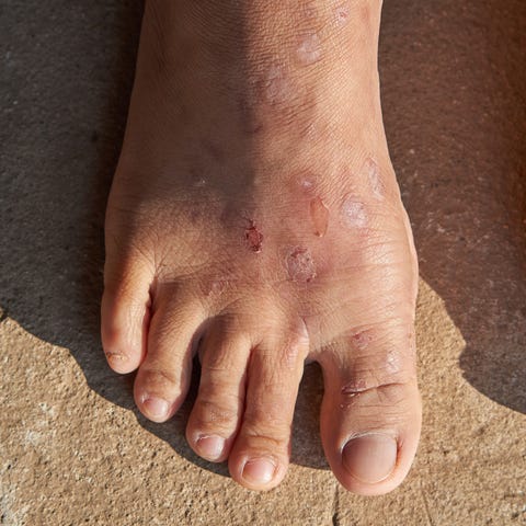 Eczema Causes Symptoms Treatments How To Get Rid Of Eczema Eczema Causes Symptoms Treatments How To Get Rid Of Eczema
