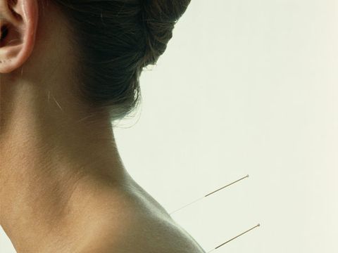 1. Acupuncture