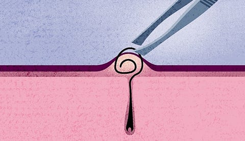 3 Ways To Safely Remove Ingrown Hairs