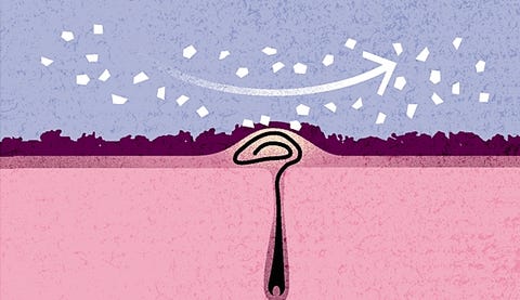 3 Ways To Safely Remove Ingrown Hairs