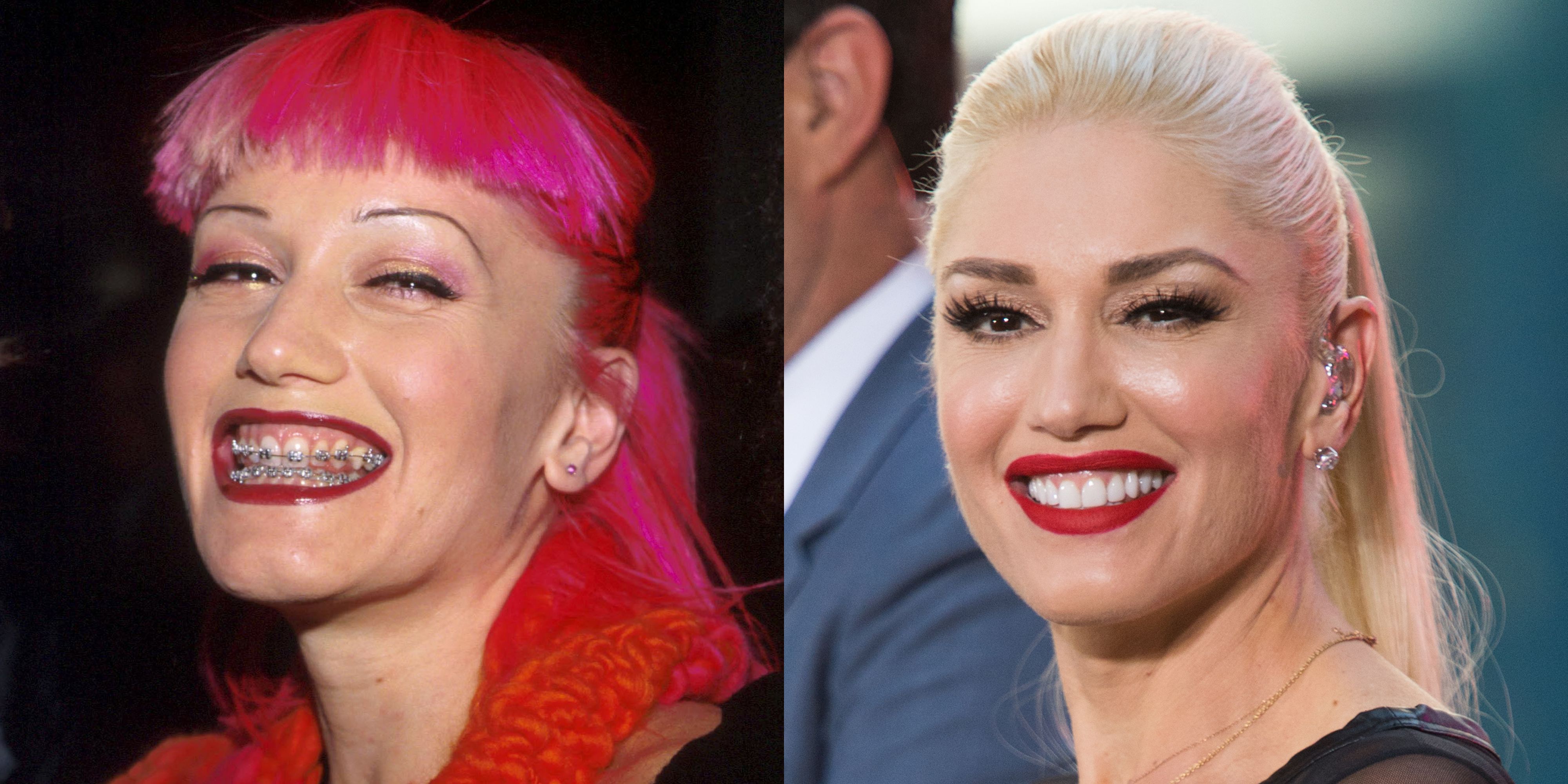 Celebrity Smiles Before And Afters - Celebrity Dental Work