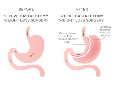 Abdominal fat reduction surgery results in 1/4 of the stomach removed.
