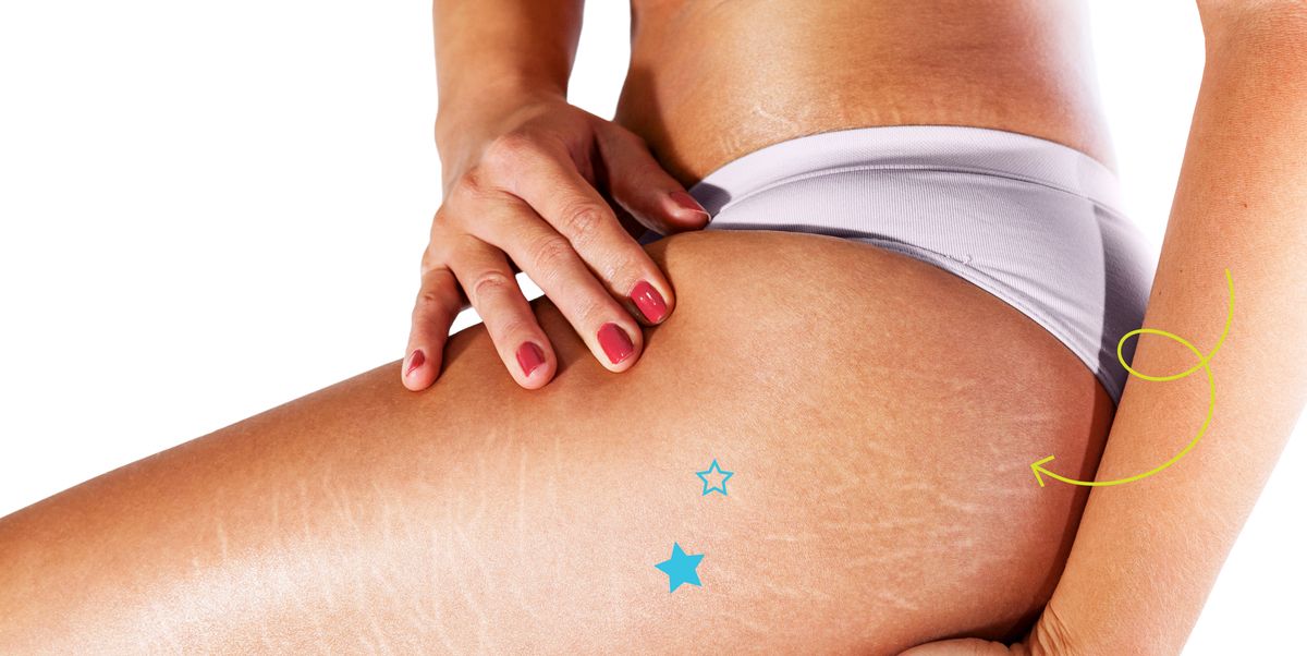How To Remove Stretch Marks – 29 Effective Home Remedies