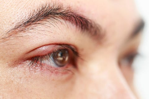 Styes Causes Prevention And Treatment