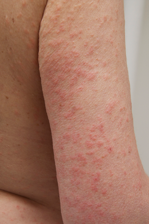 What Does A Sun Poisoning Rash Look Like Sun Poisoning Symptoms