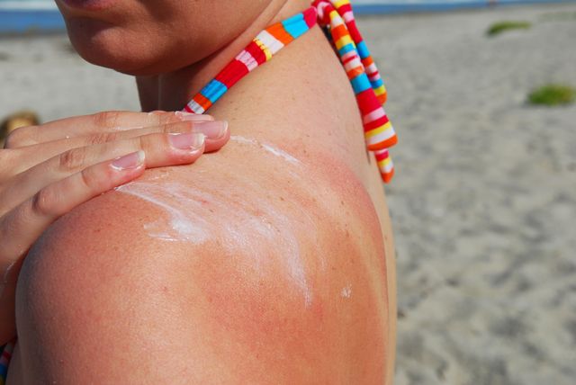 how to get rid of sun burn   women's health uk