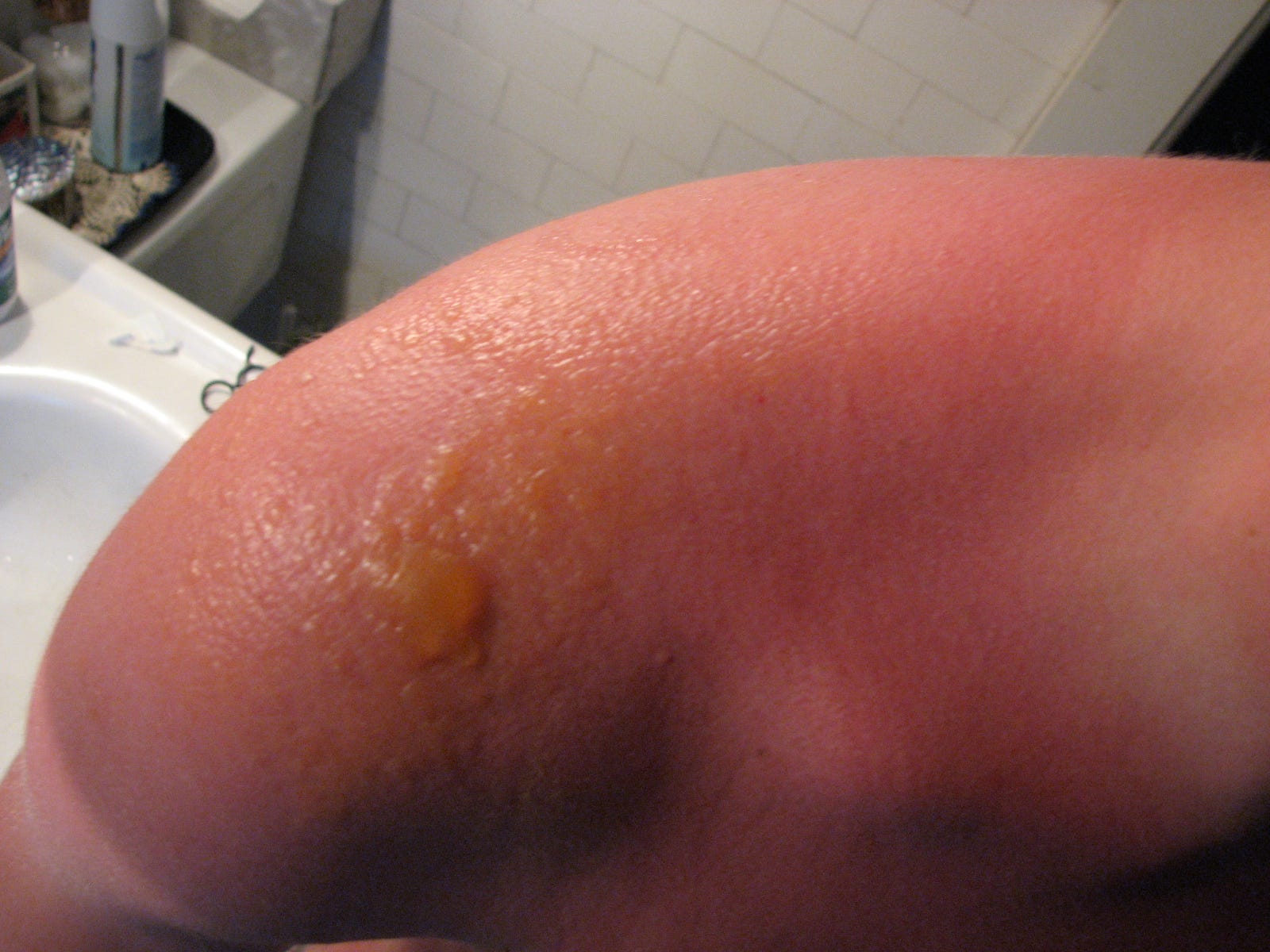 sunburn blister