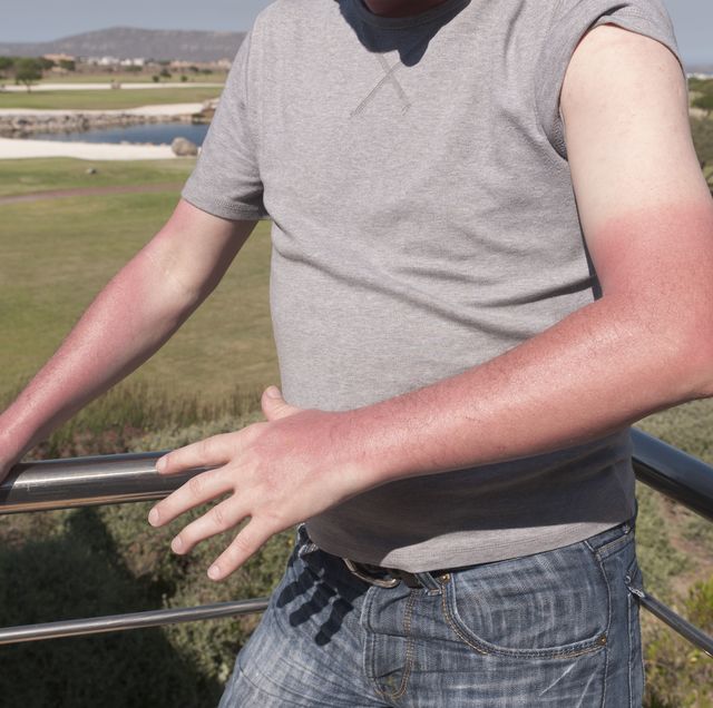 The Stages Of A Sunburn How A Sunburn Affects Your Skin