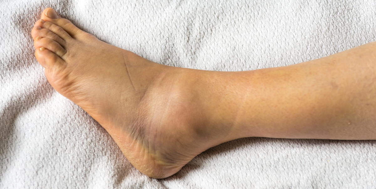 12 Causes Of Swollen Ankles Feet Why Are My Ankles Swollen