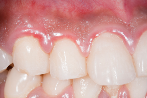 swollen gums gingivitis swollen gums gingivitis