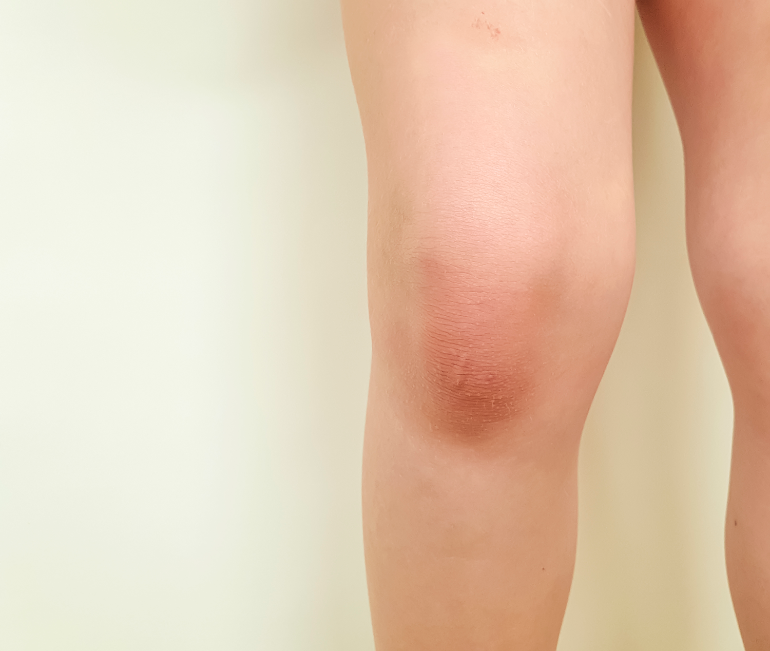 swelling below knee cap