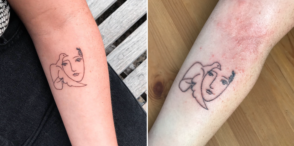 Allergic reaction to tattoo treatment