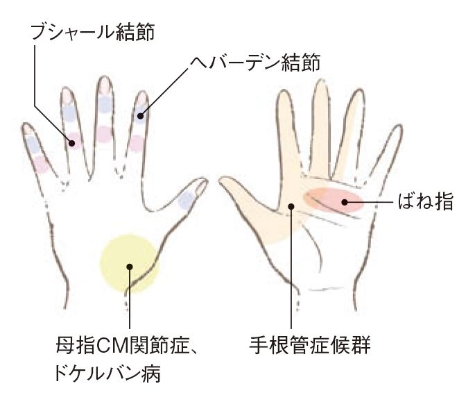 一 痛み 関節 第 親指