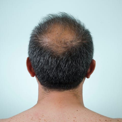 Male Pattern Baldness: How to Fight Hair Loss Male Pattern Baldness: How to Fight Hair Loss