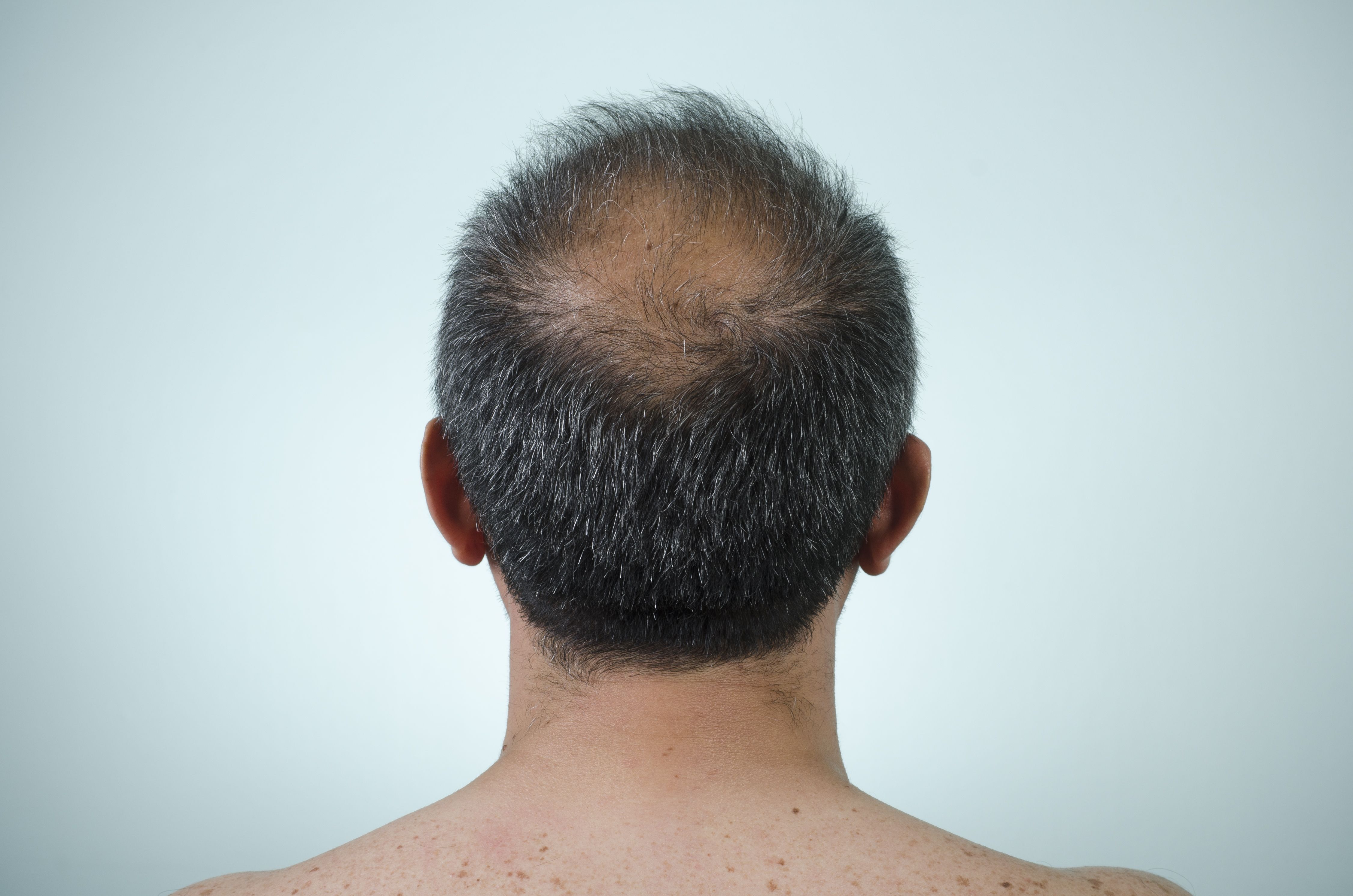 hair loss at 20 male solution