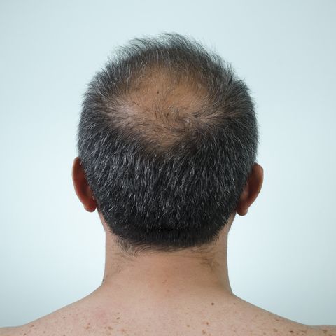 How To Fight Male Pattern Baldness