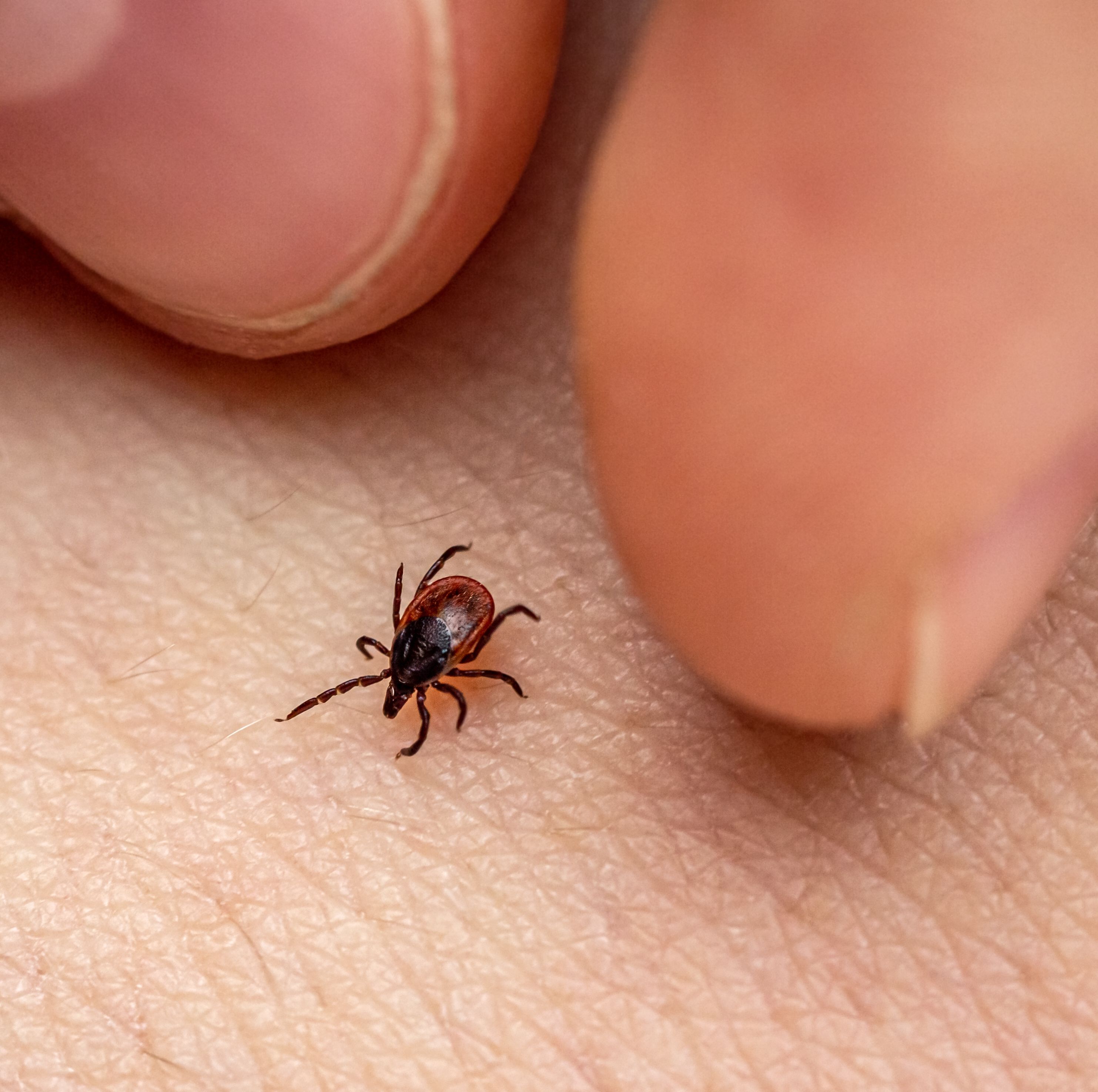 How to Remove a Tick Head From Your Skin—the Right Way