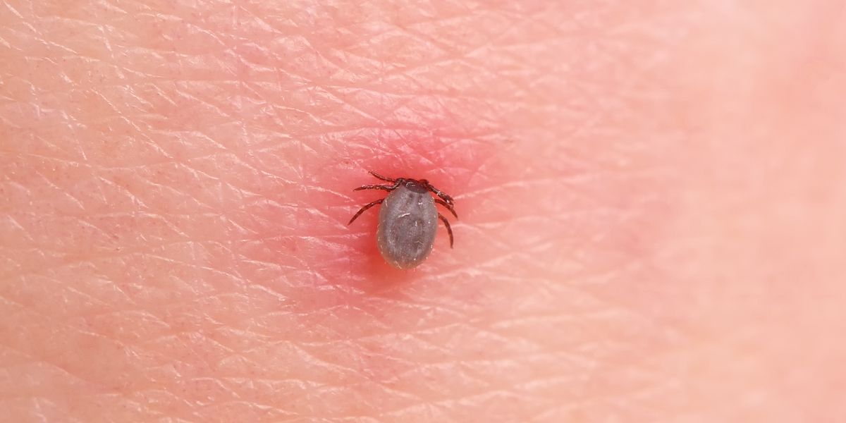 The Best Way to Treat a Tick Bite, According to Dermatologists - Prevention.com