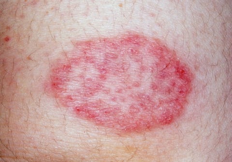 tinea infection