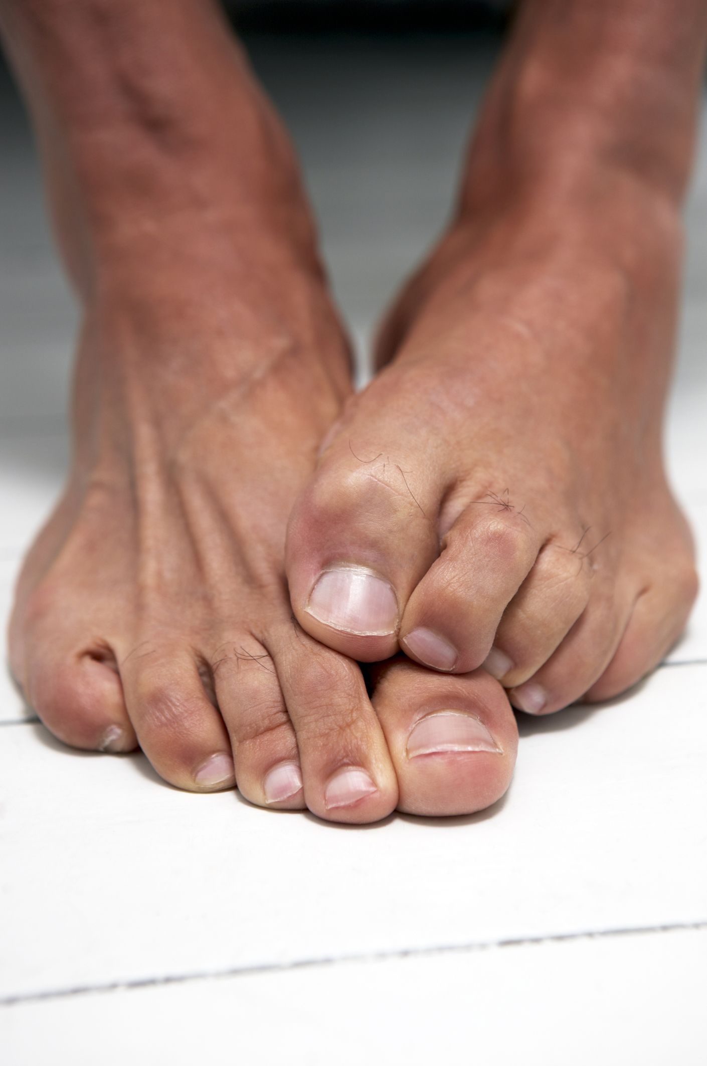 Cracked Toenail | Foot Specialist Toronto | Feet First Clinic