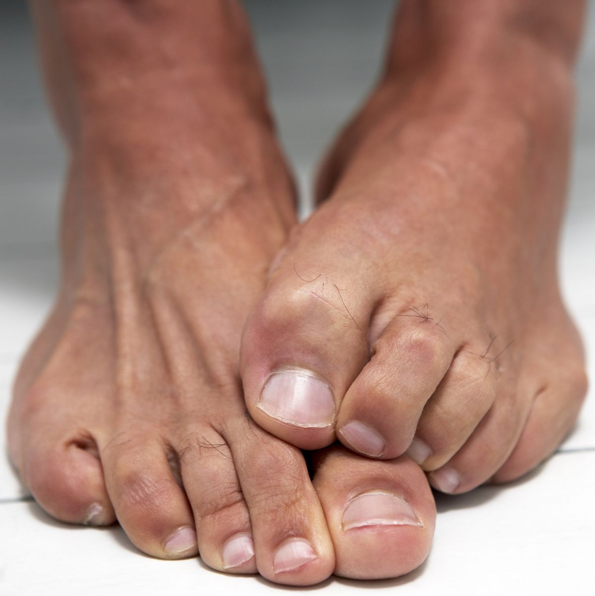 Toe amputation: causes, surgery, recovery and complications