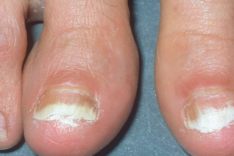 How To Cure Toenail Fungus In 10 Minutes
