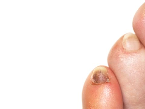 Spot toenail black under When to