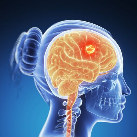 Nursing Student Mistakes Aggressive Brain Tumor for Bad Hangover