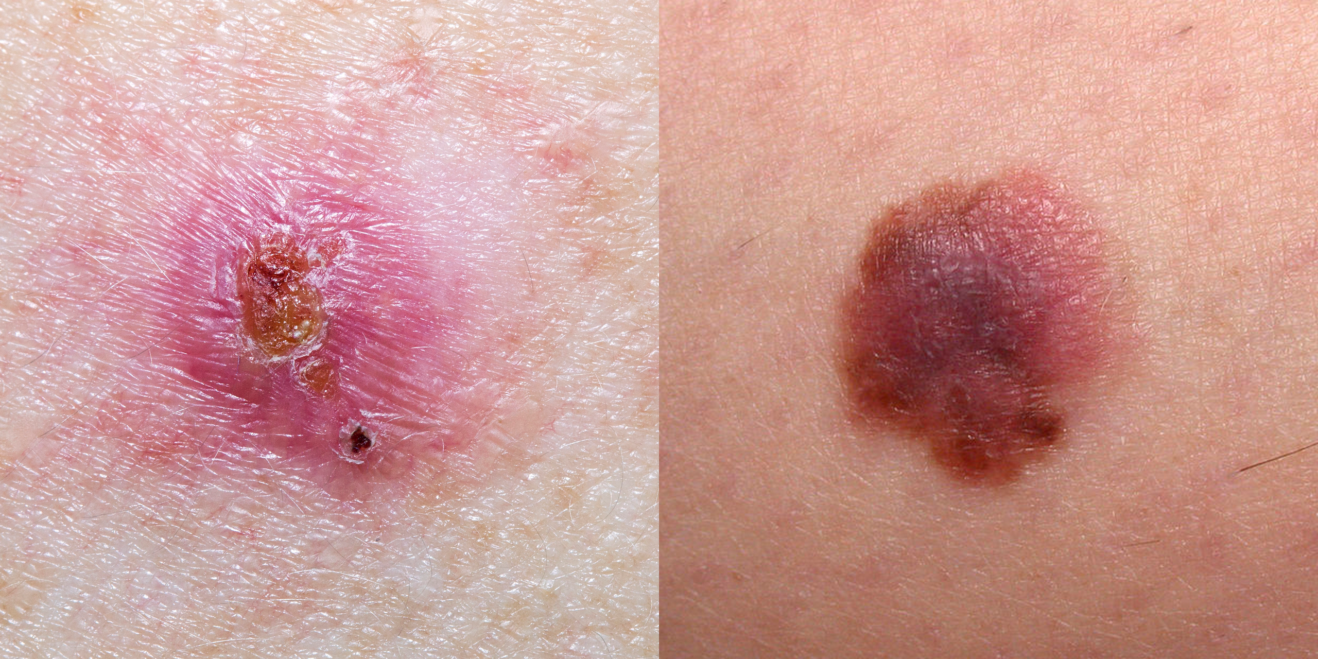 Skin Cancer Pictures 5 Different Types Of Skin Cancer To Know   Types Of Skin Cancer Pictures 1560292088 