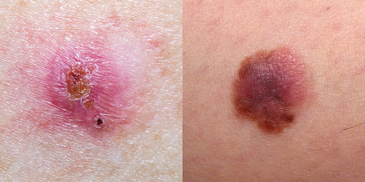 Skin Cancer Pictures 5 Different Types Of Skin Cancer To