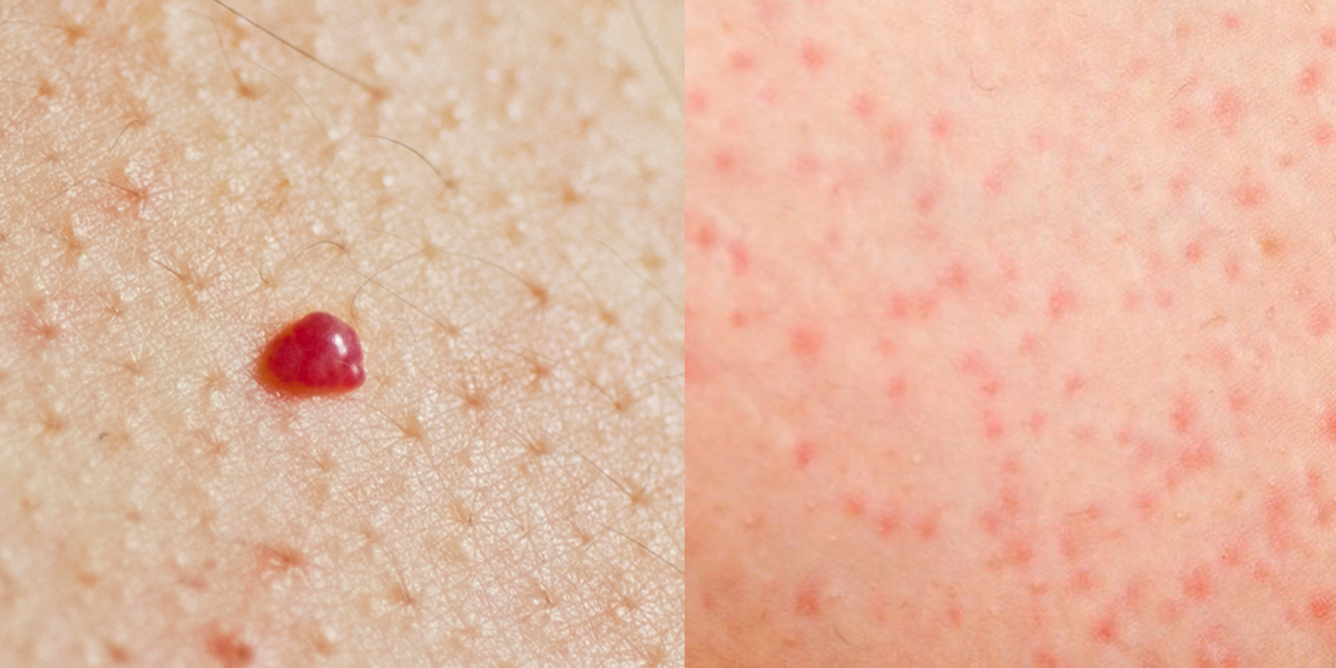 Bright Red Bumps On Skin