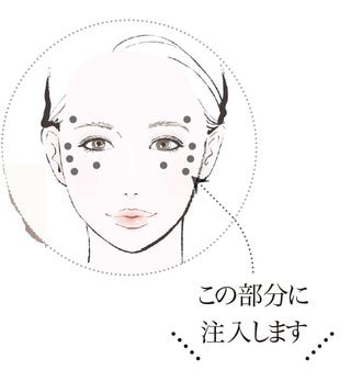 眼瞼下垂 未満のたるみまぶた 美容医療で解決します 注入治療 編 眼瞼下垂 未満のたるみまぶた 美容医療で解決します 注入治療 編