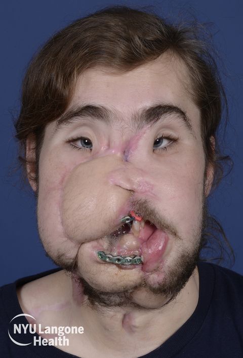 Cameron Underwood Face Transplant