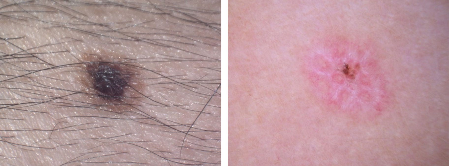 loss of Color mole 