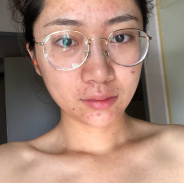痘痘要怎麼擠才不會留痘疤 韓國美容師教妳5招正確擠痘痘小撇步 痘痘要怎麼擠才不會留痘疤 韓國美容師教妳5招正確擠痘痘小撇步