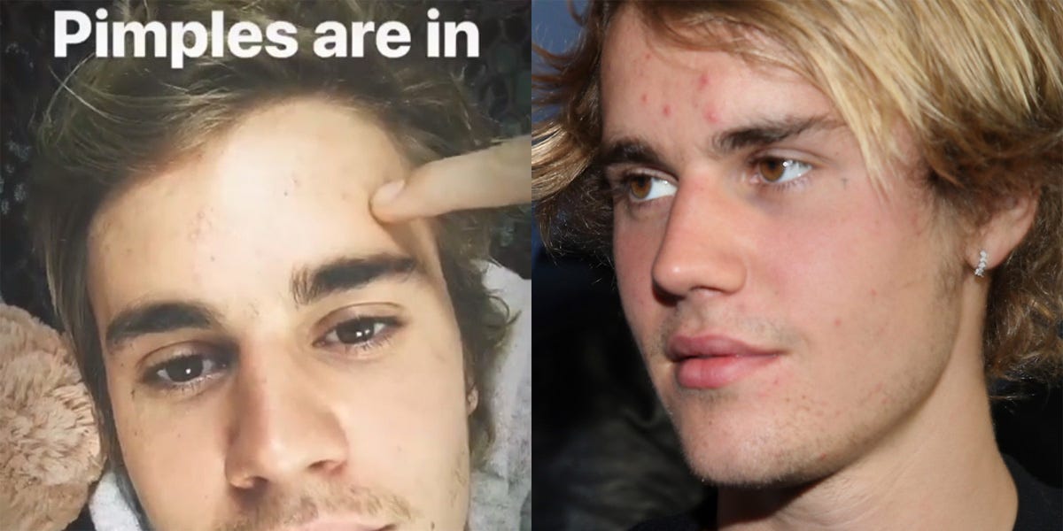 Justin Bieber Shares Pimple Selfie On Instagram Justin Bieber Acne