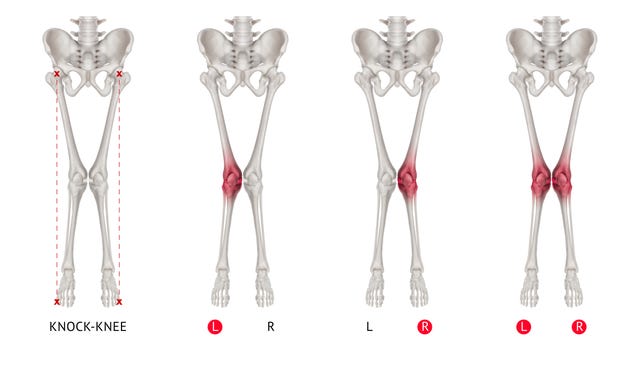 Pierna de alineación o Knock-knee resaltados en rojo en la zona de la articulación de la rodilla- ilustración médica- Salud-Anatomía humana y concepto médico -Aislado sobre fondo blanco.