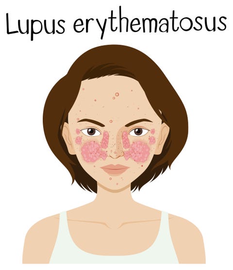 Lupus Erythematosus body aches