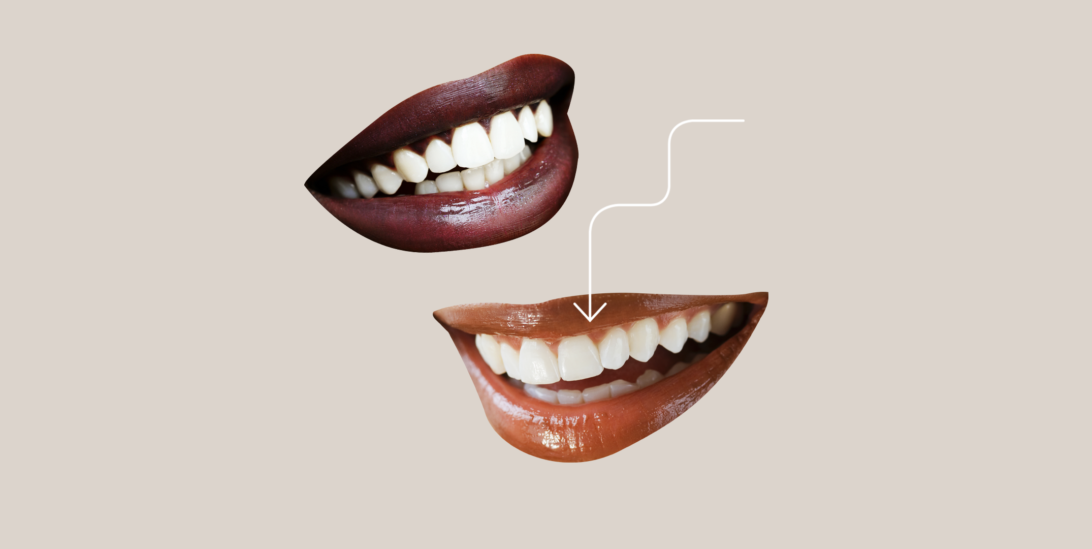 Dental Veneers