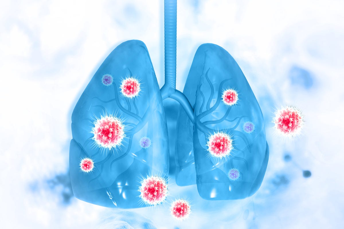 What Is Double Pneumonia