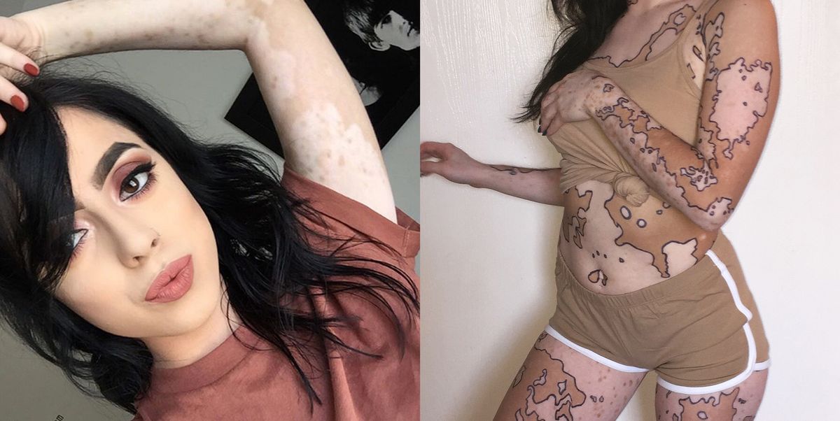 Ashley Soto, body art, skin, skin condition, skin disease, vitiligo.