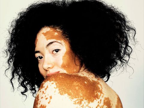 vitiligo instagram