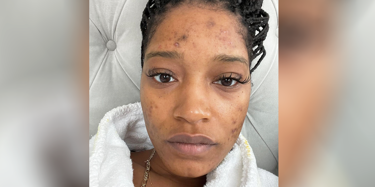 Keke Palmer Talks About PCOS, Acne In No-Makeup Instagram Photos