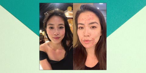 Cbs Frances Wang Posts Photos Of Perioral Dermatitis Face Rash