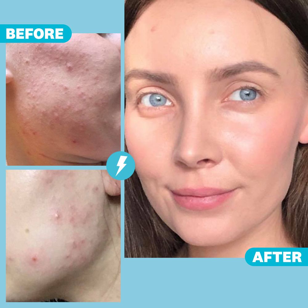 Quitting Dairy And Holistic Acne Treatment Helped Clear My Acne